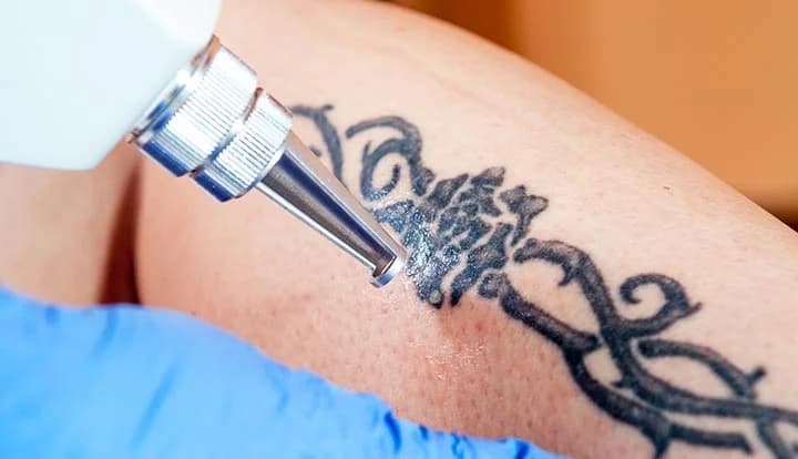 tattoo laser center 1